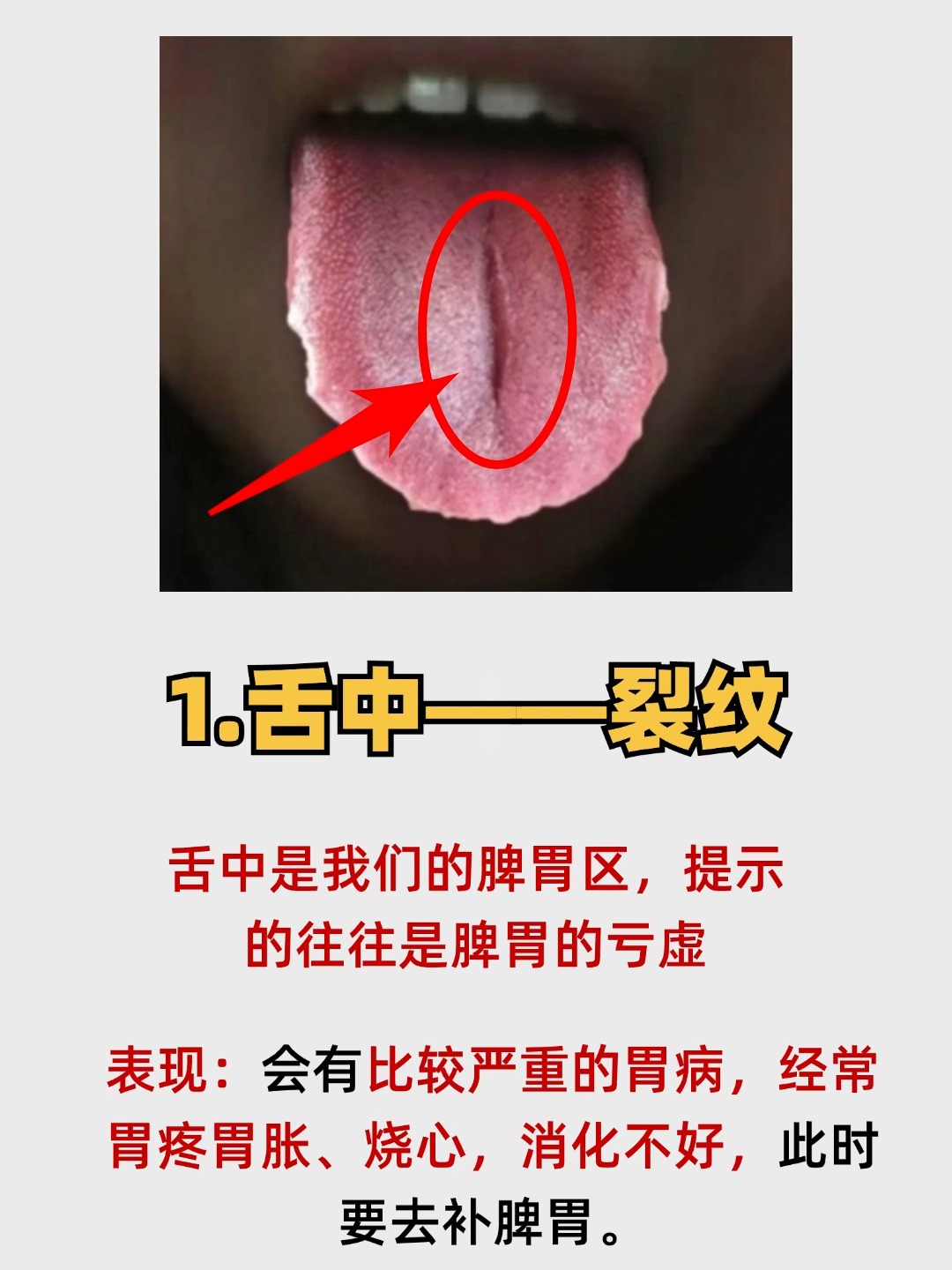 舌裂是什么原因造成的