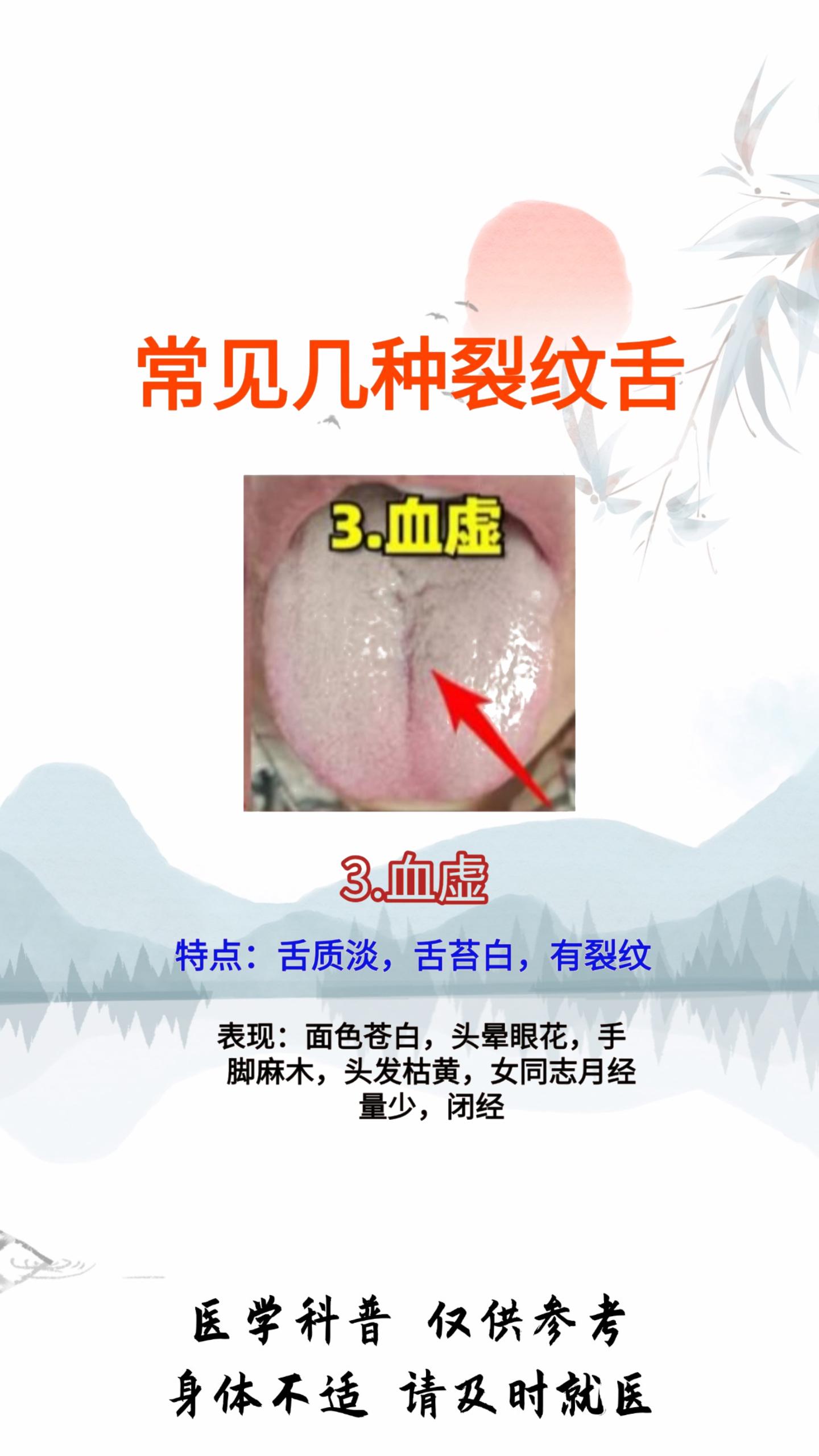 舌裂是什么原因造成的