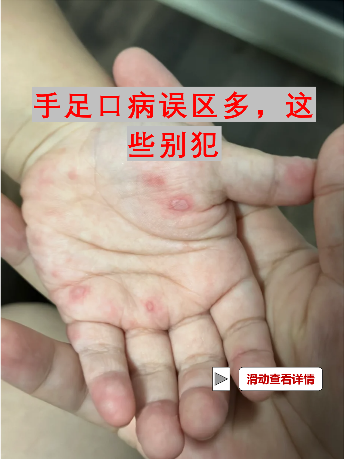 手足口病是怎么引起的?