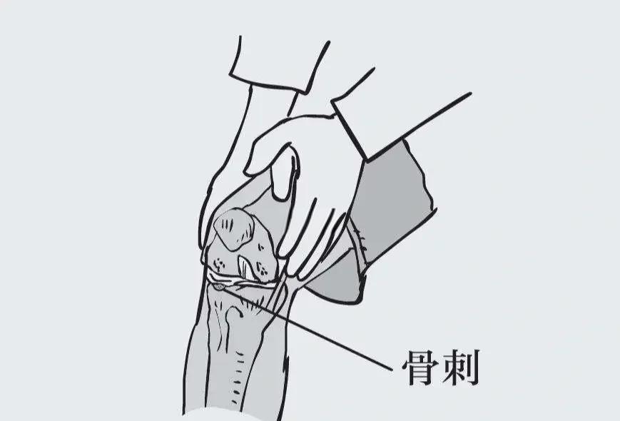 膝盖长骨刺怎么办?