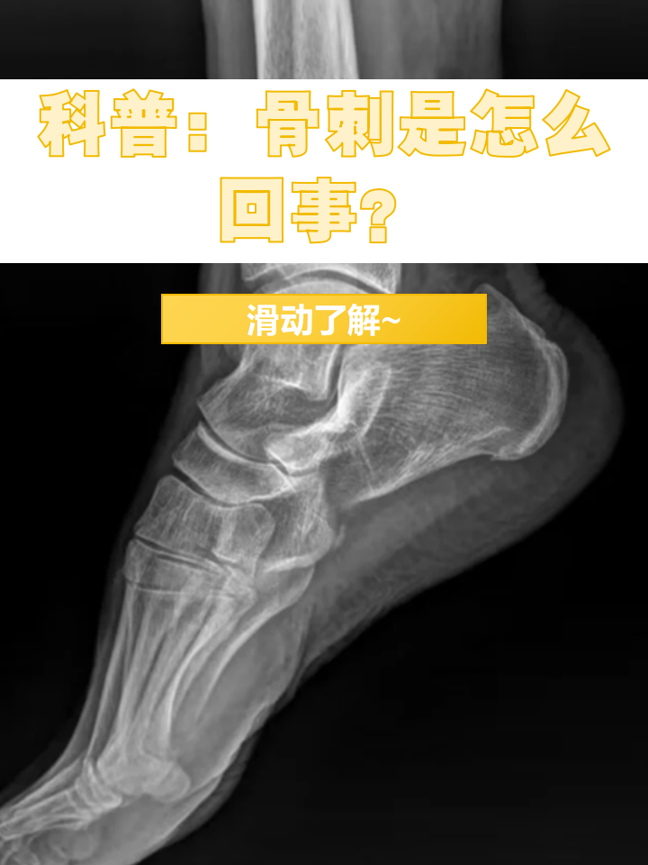 膝盖长骨刺怎么办?