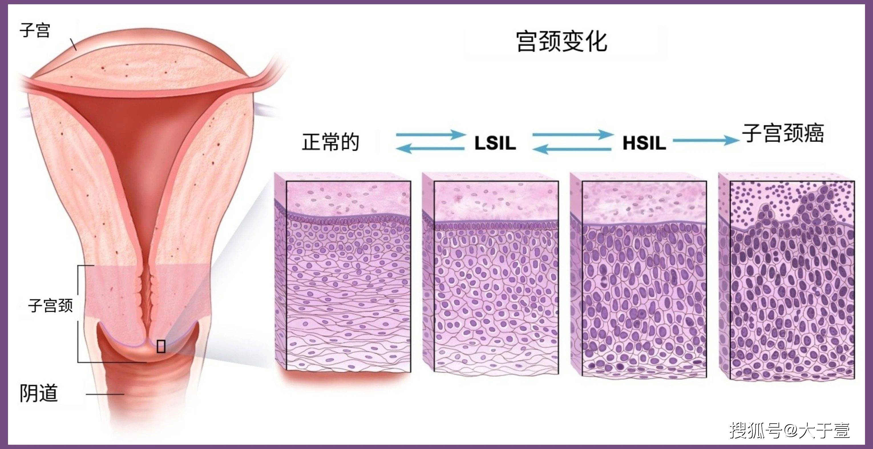 宫颈鳞状细胞癌恶性程度高吗