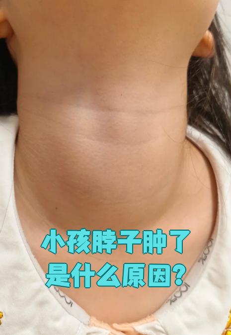 脖子肿大是什么病