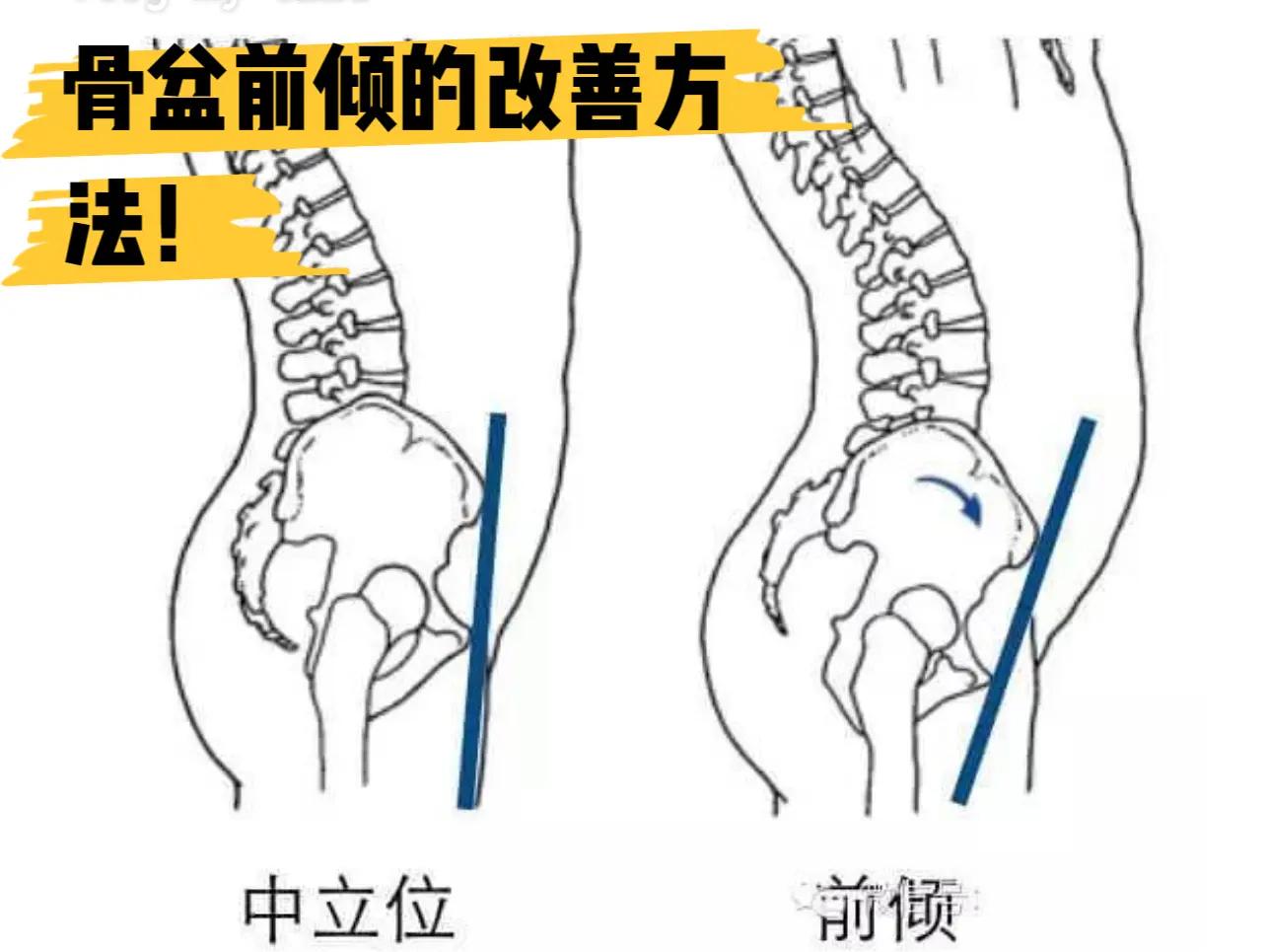 骨盆前倾如何纠正?