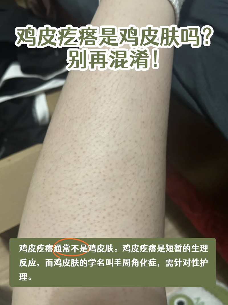 毛周角化症能根治吗?