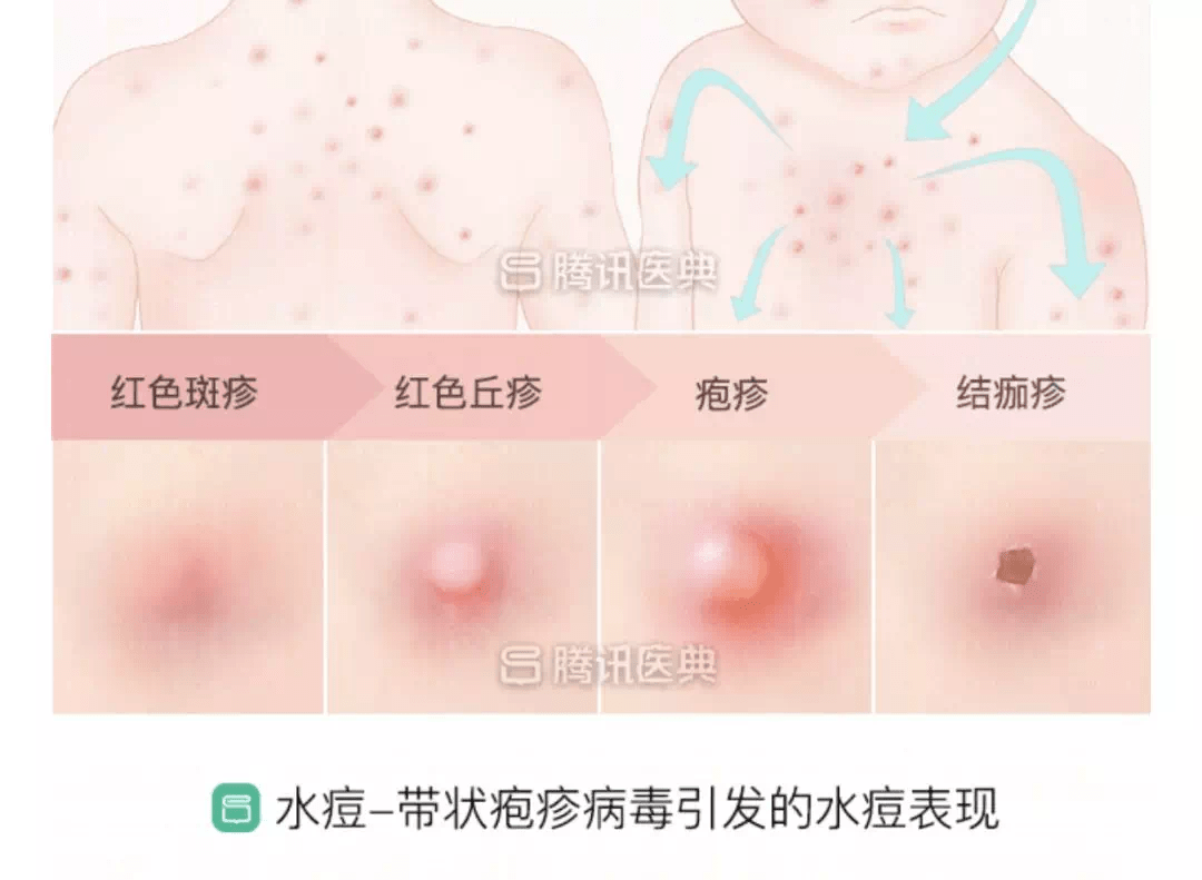 水痘的征兆