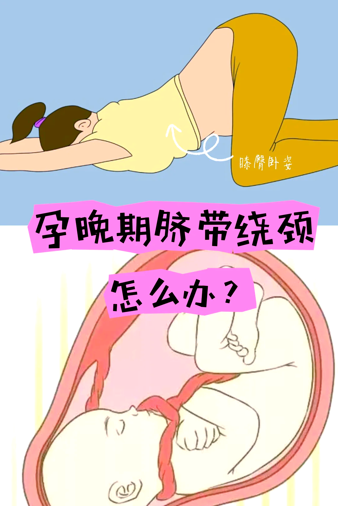 胎儿脐带绕颈该怎么办