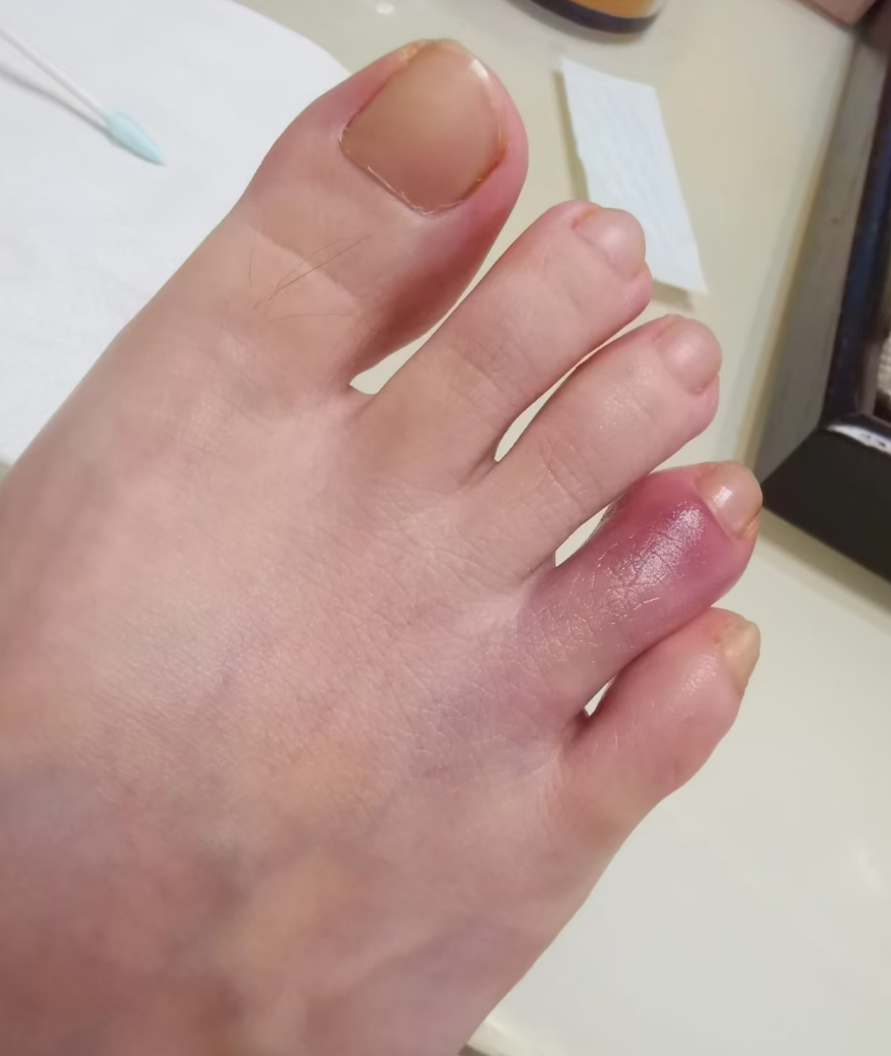 大母脚趾外侧按压疼.