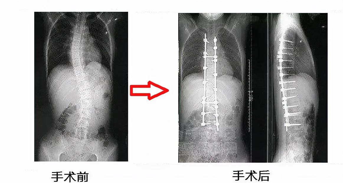 脊柱侧弯手术有哪些
