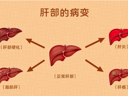 慢性肝病是什么
