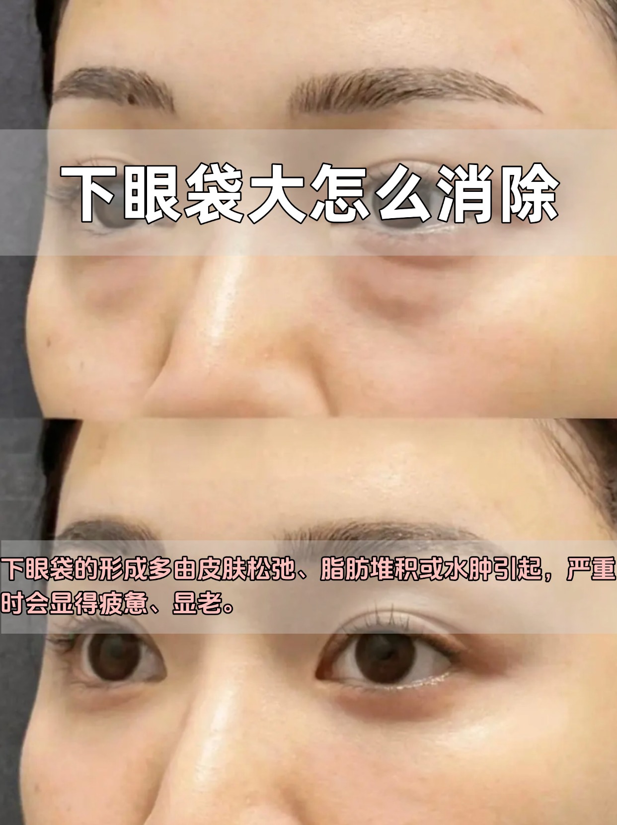 下眼袋浮肿是什么原因