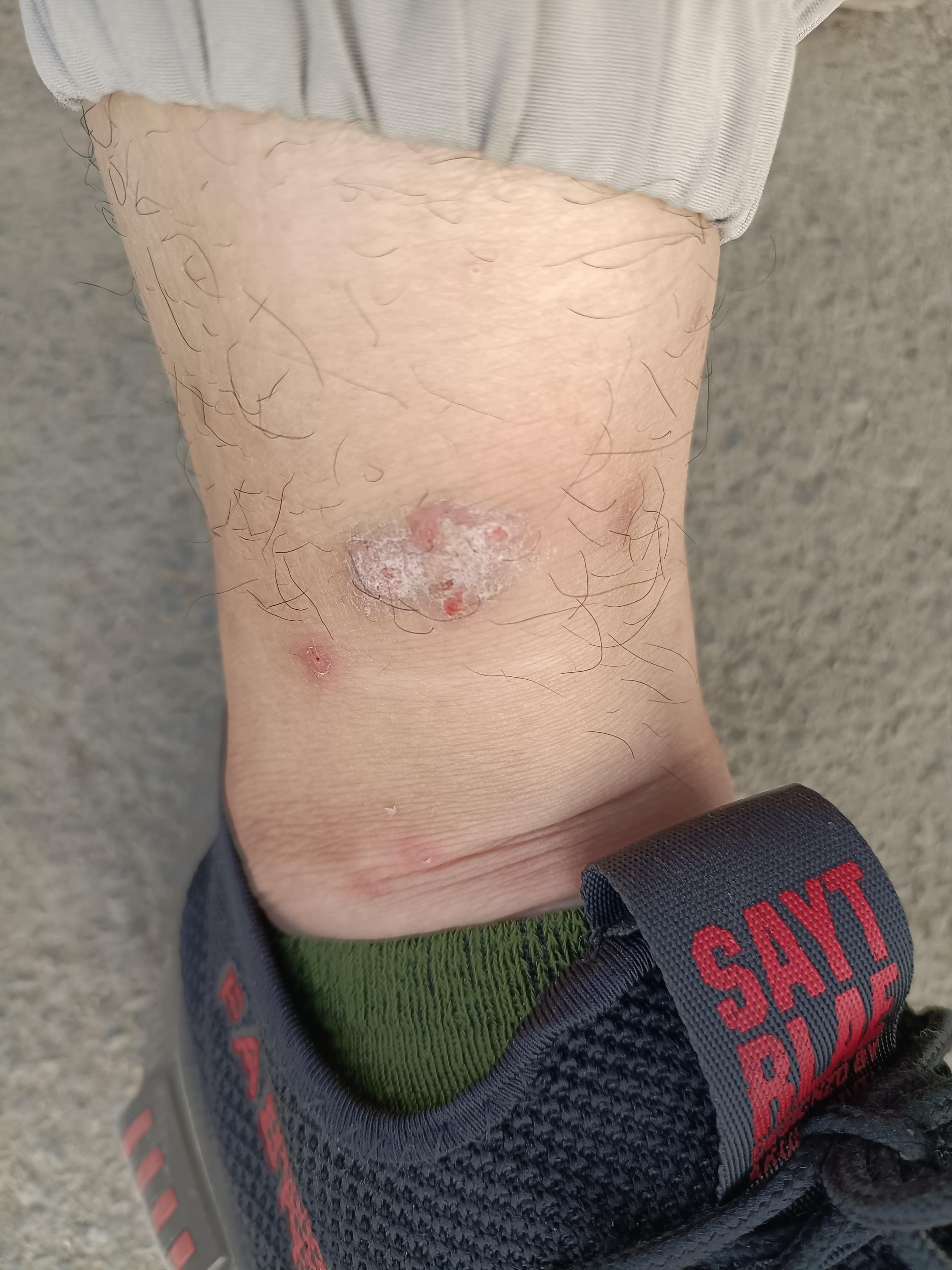 被毛毛虫咬了怎么办