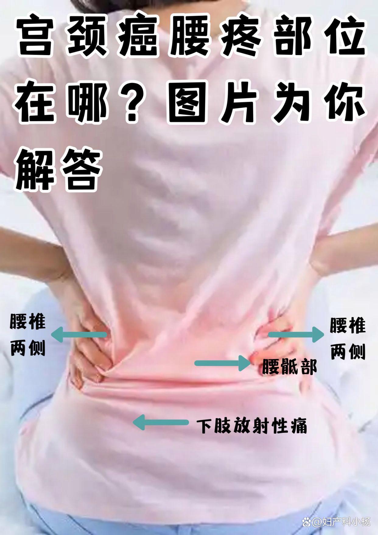 腰骶部疼痛的原因