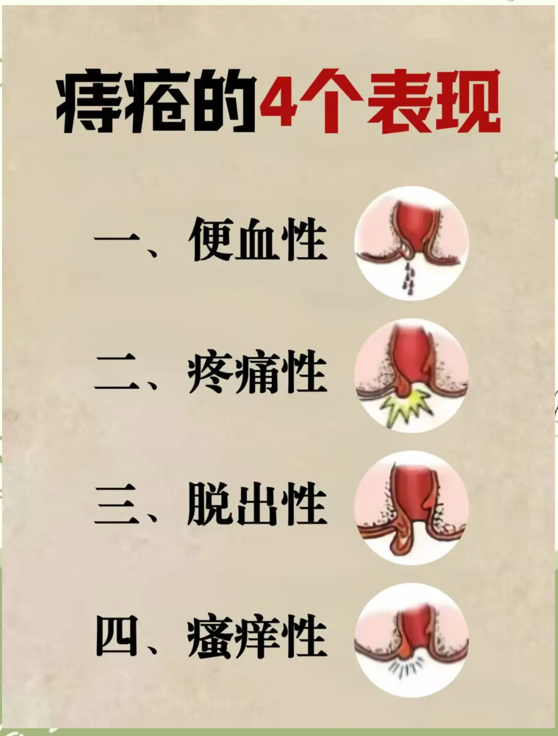 外痔疮的最佳治疗方法是什么