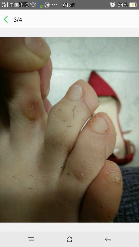 脚趾头缝里长得小疙瘩