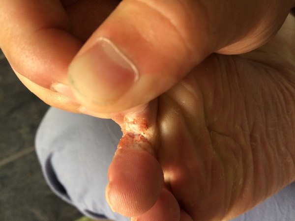 脚趾头缝里长得小疙瘩