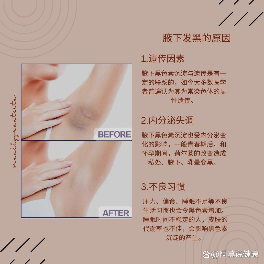 腋窝黑怎么办