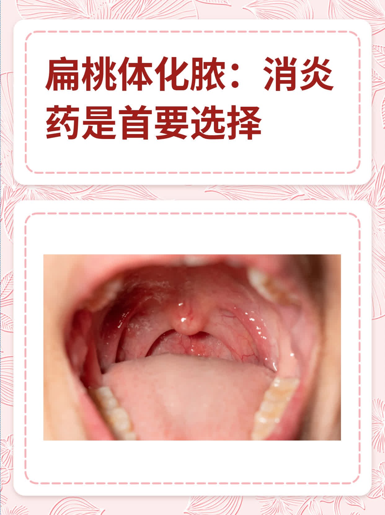 扁桃体发炎可以治好吗