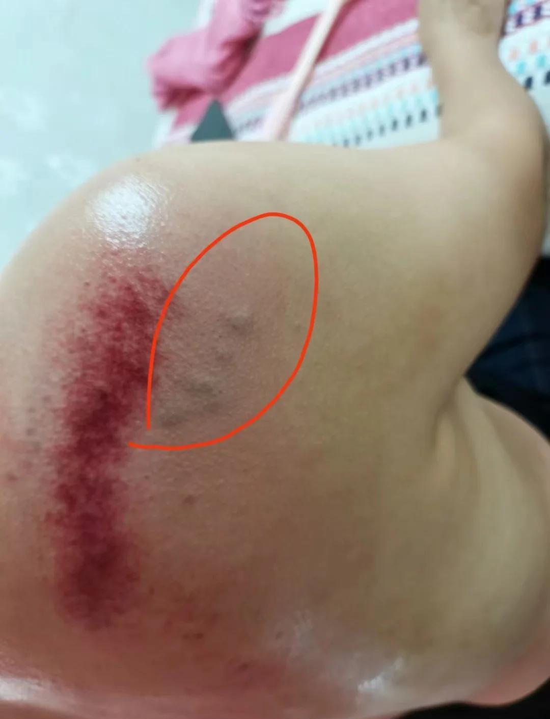 孕妇能刮痧吗???