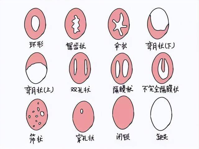 处女膜修复手术