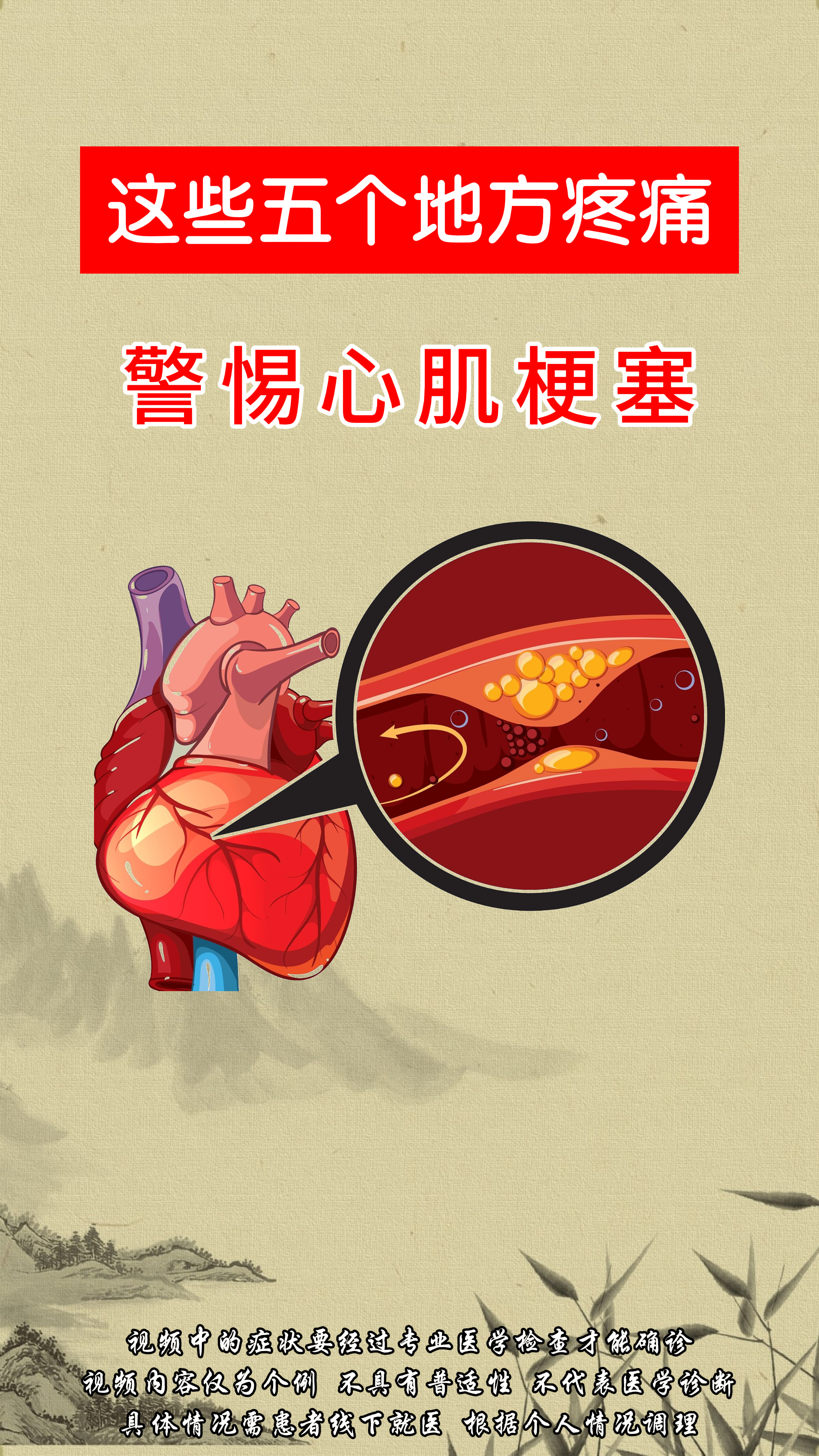 什么叫急性心肌梗塞