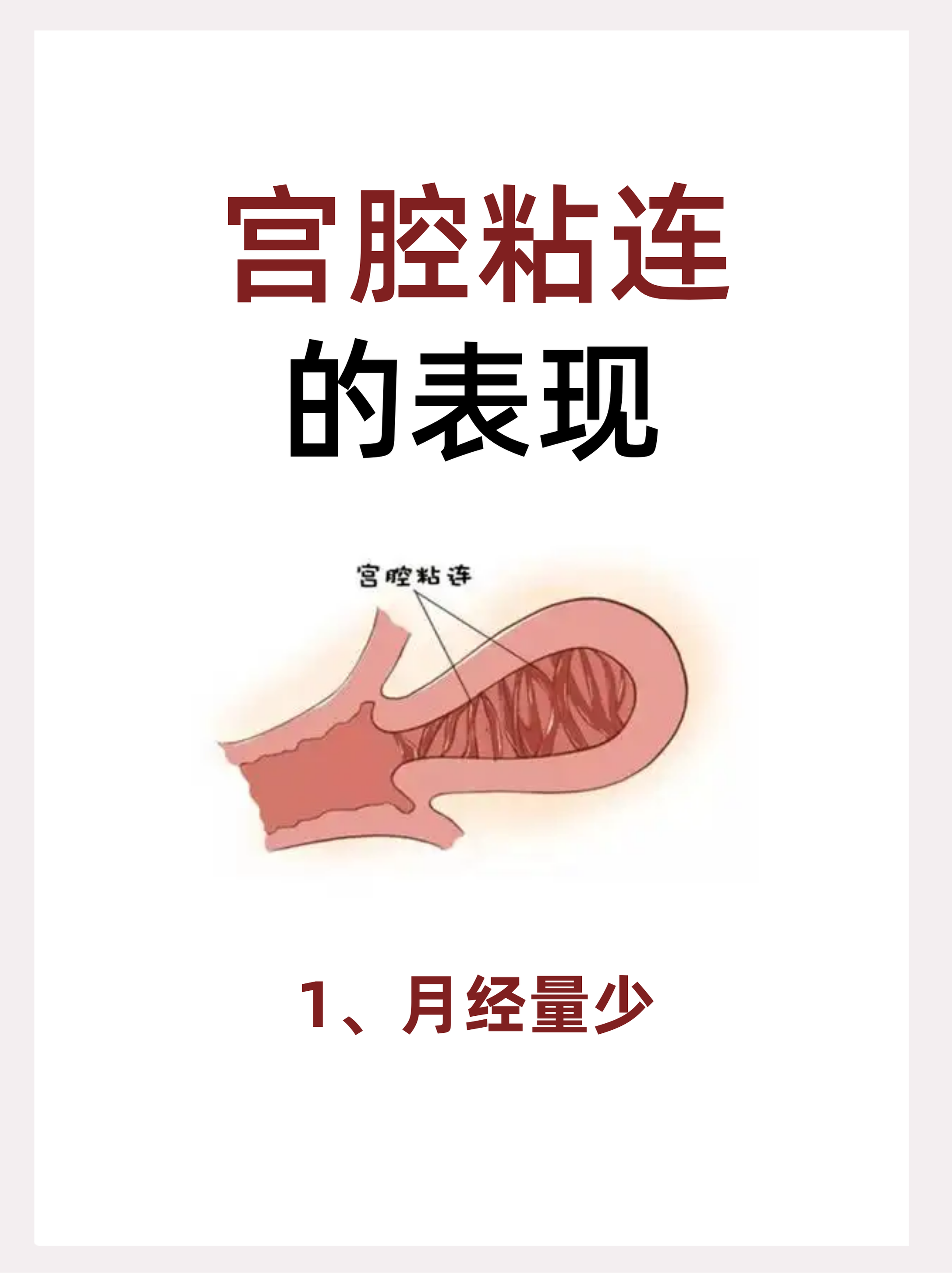 什么是宫腔积液?