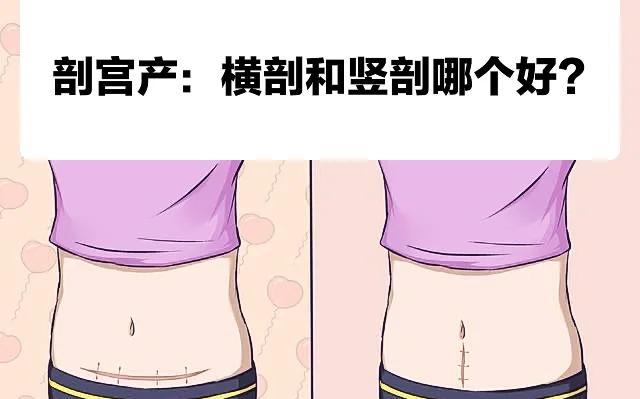 顺产与剖腹产的区别
