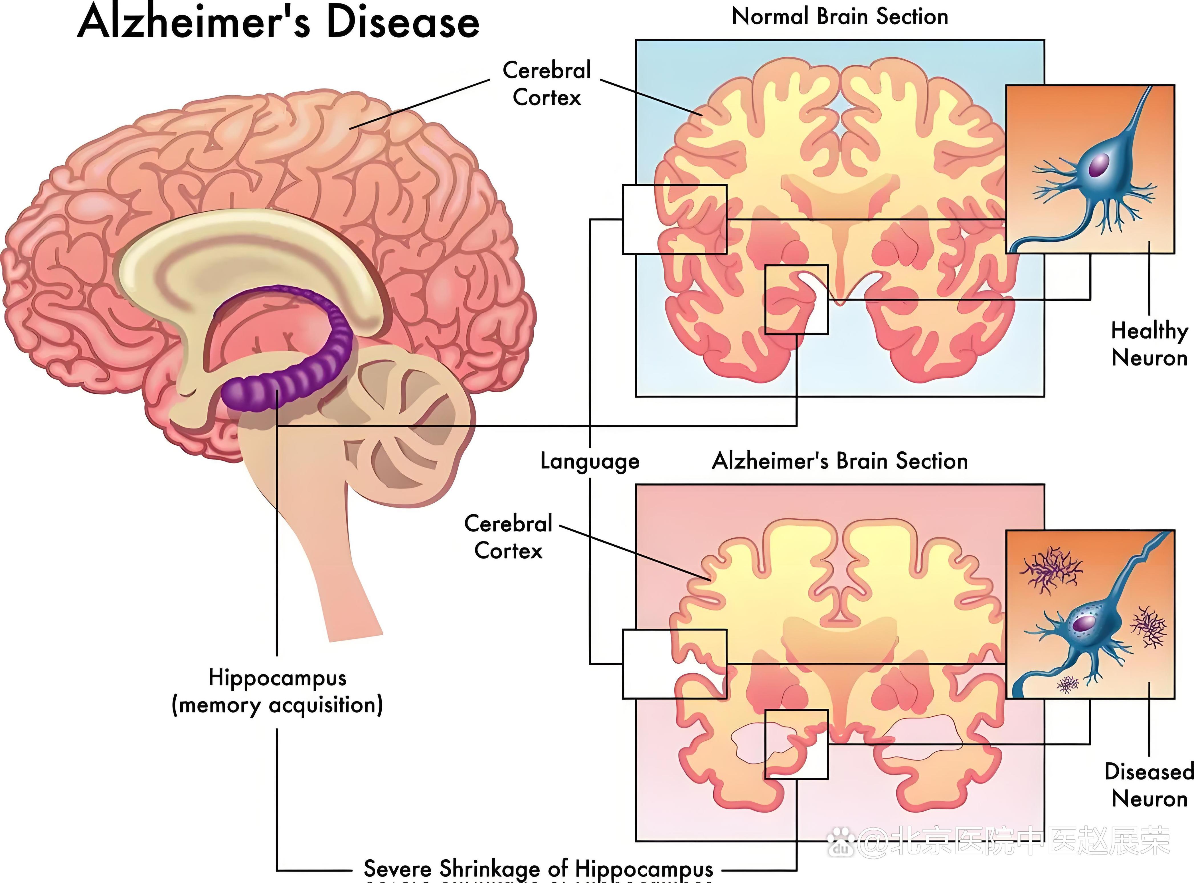 脱髓鞘脑病的症状