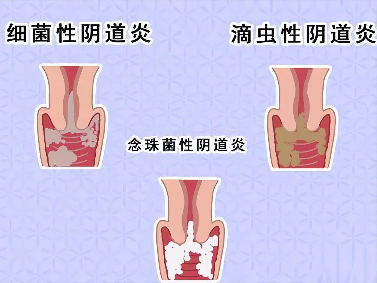 霉菌性阴炎怎么得的???