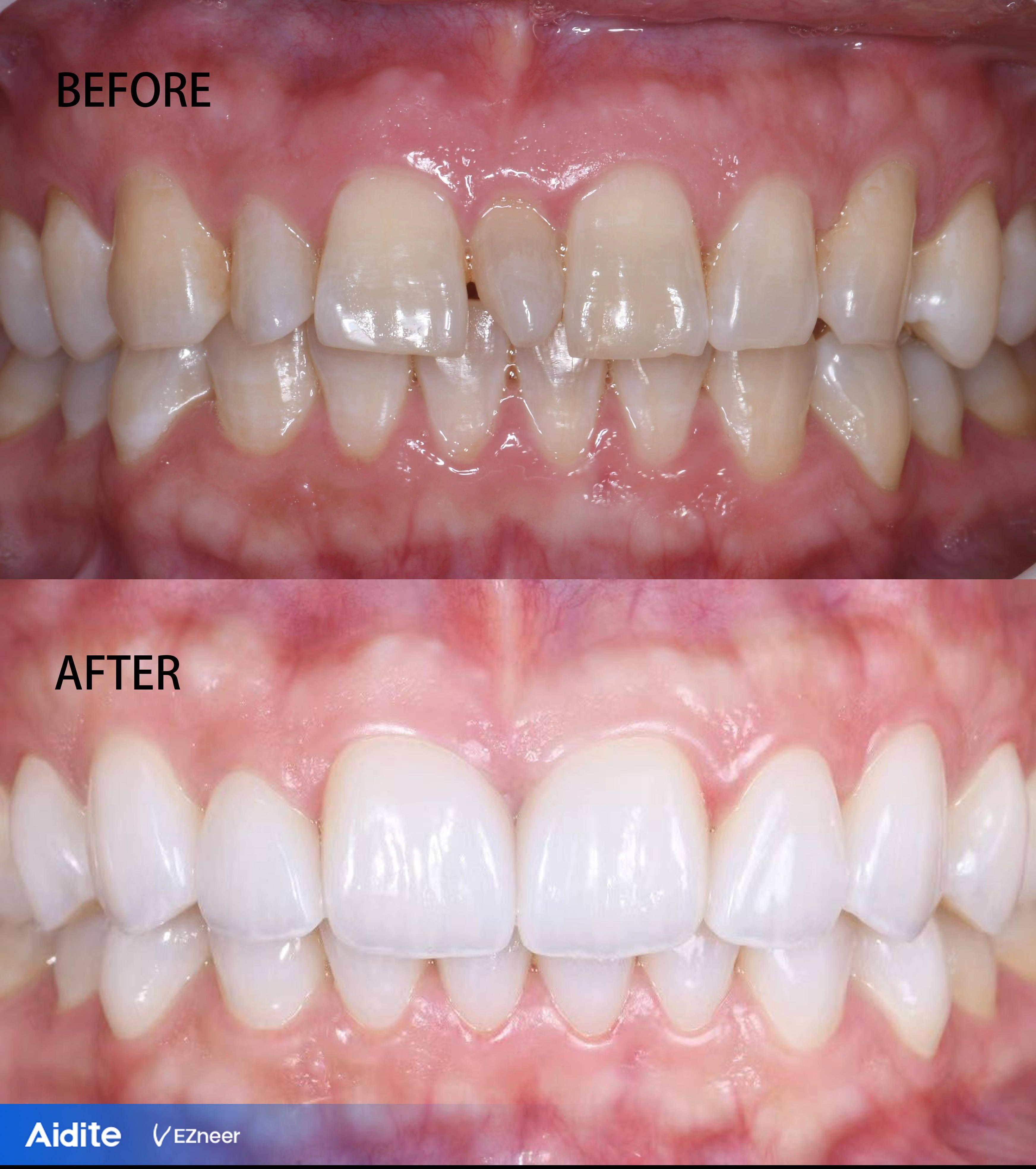 全瓷牙和烤瓷牙哪个好