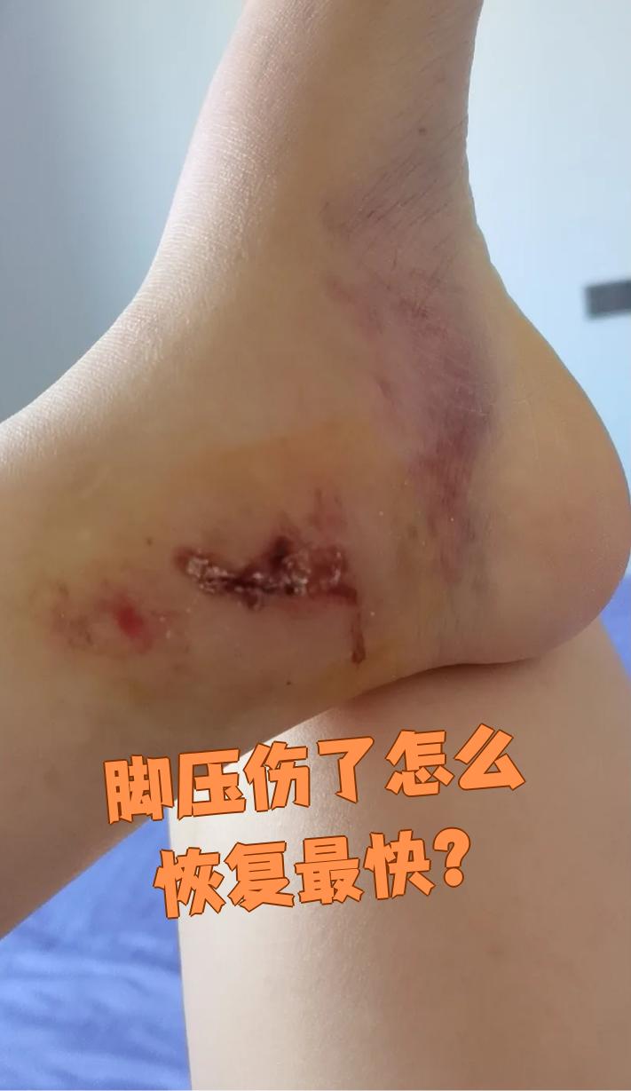 脚摔伤了怎样才能消肿