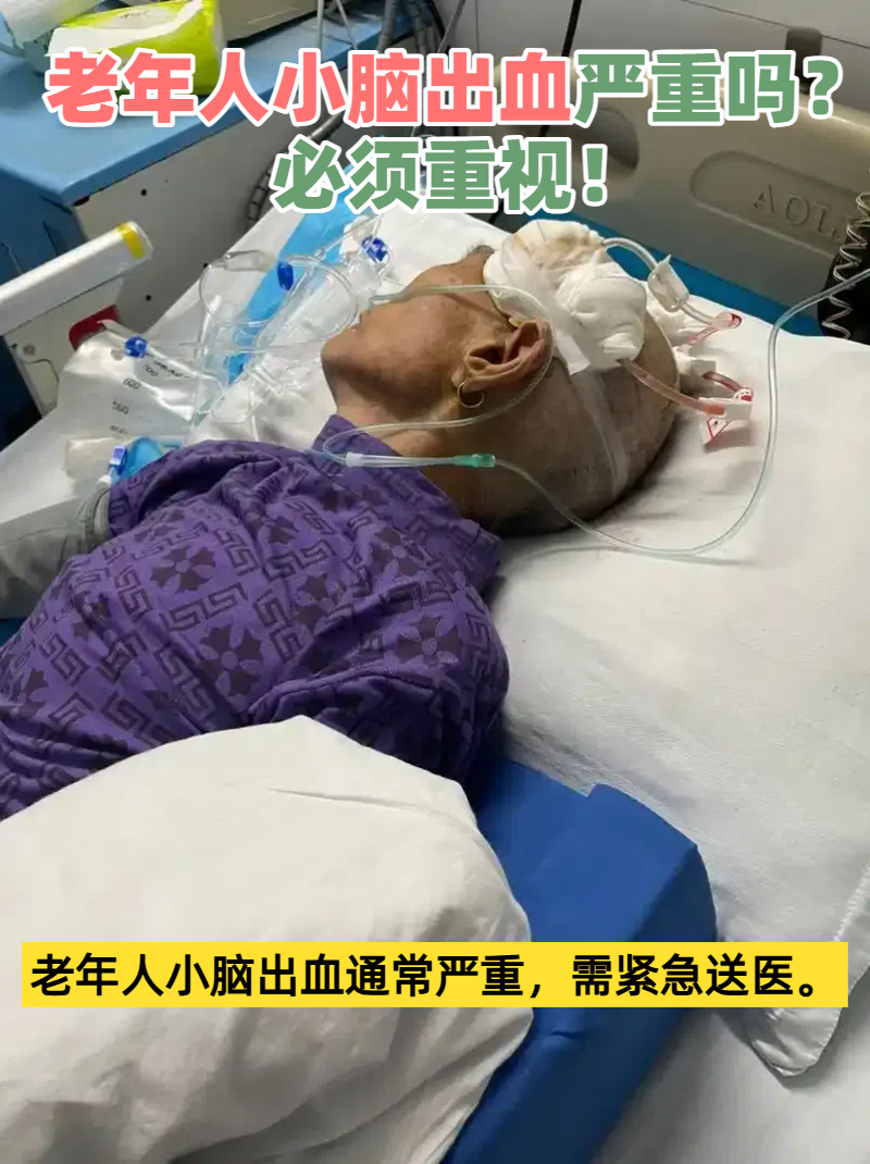 脑出血很严重吗?