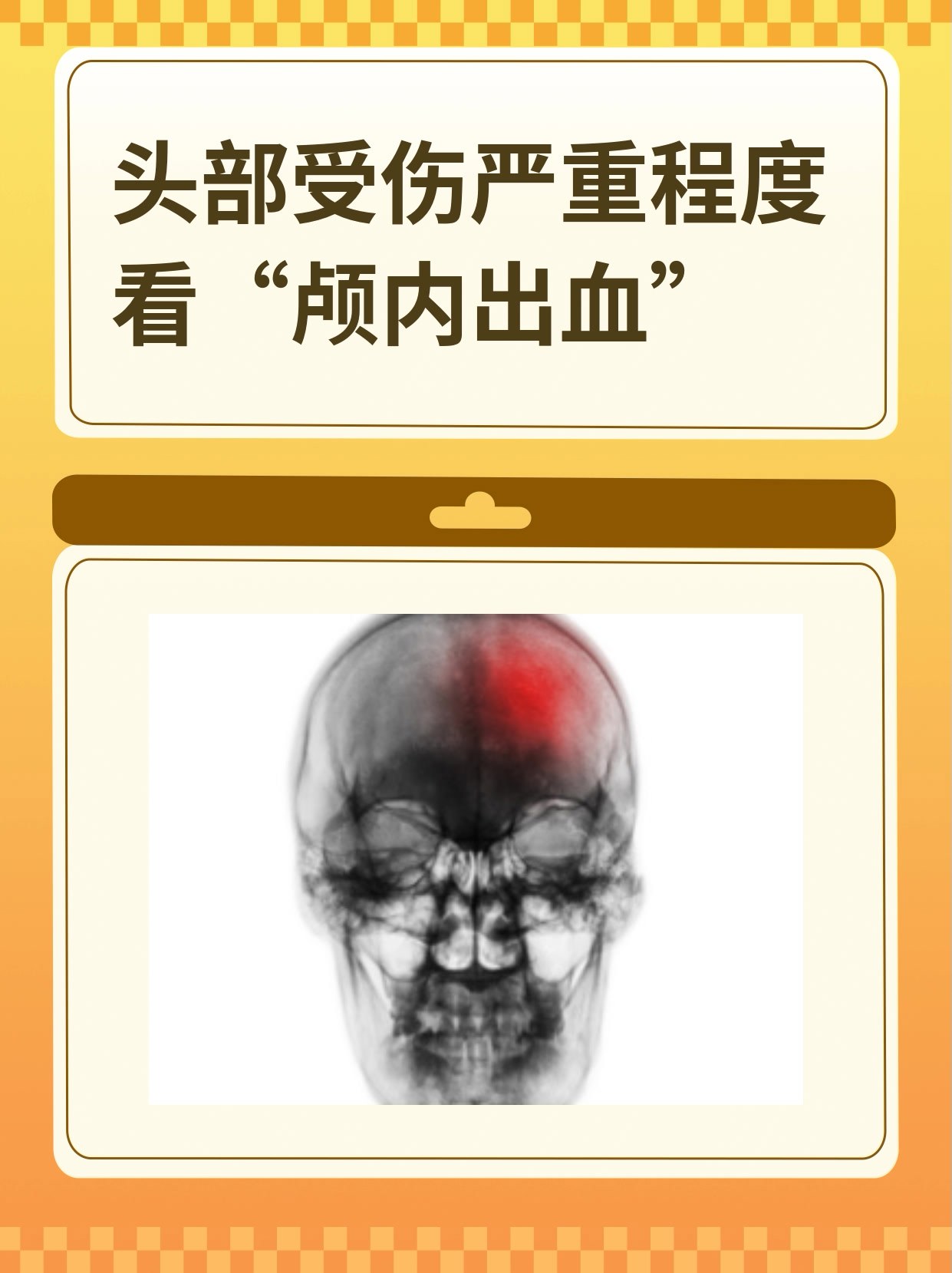 脑出血很严重吗?