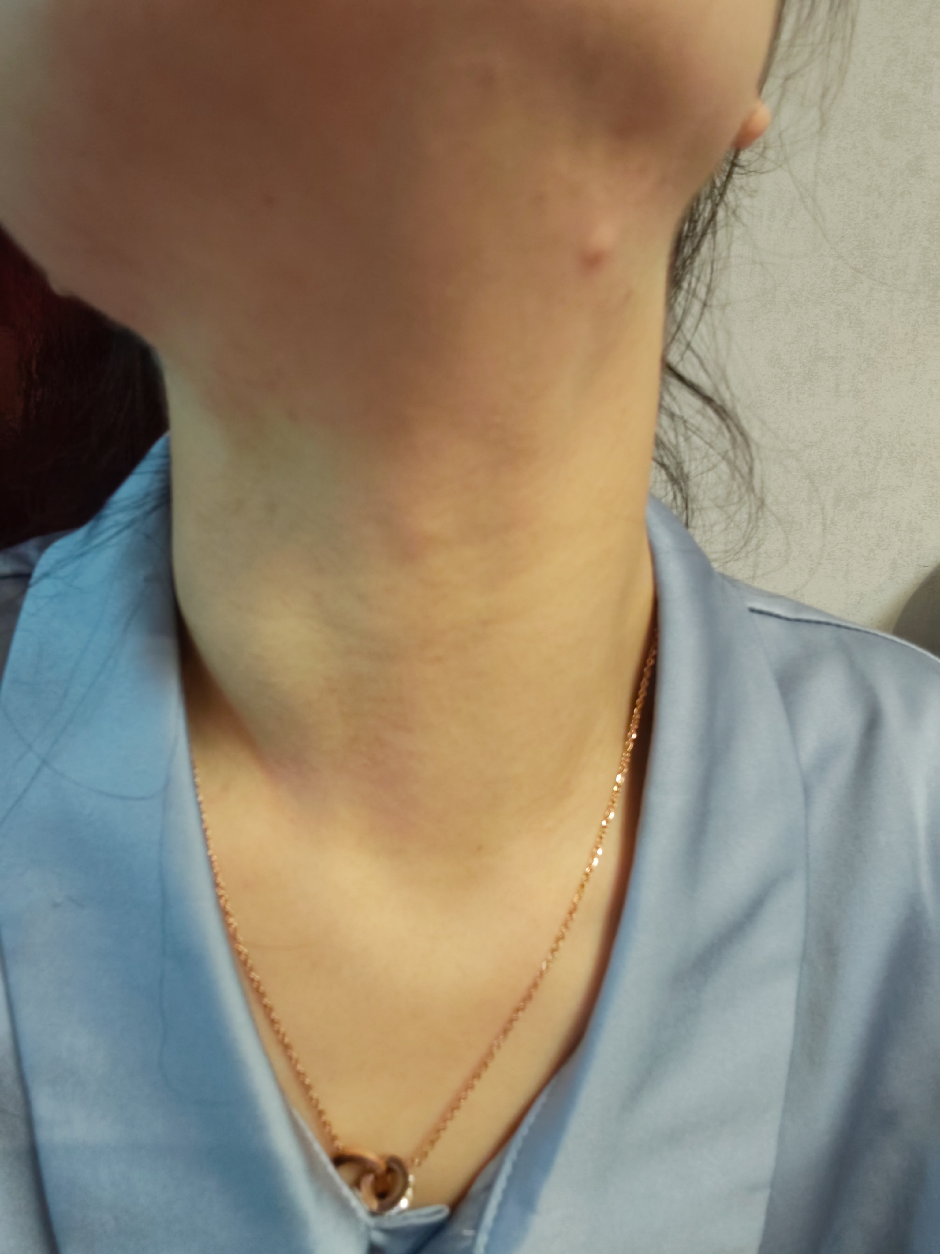 脖子痒,挠的红了一片