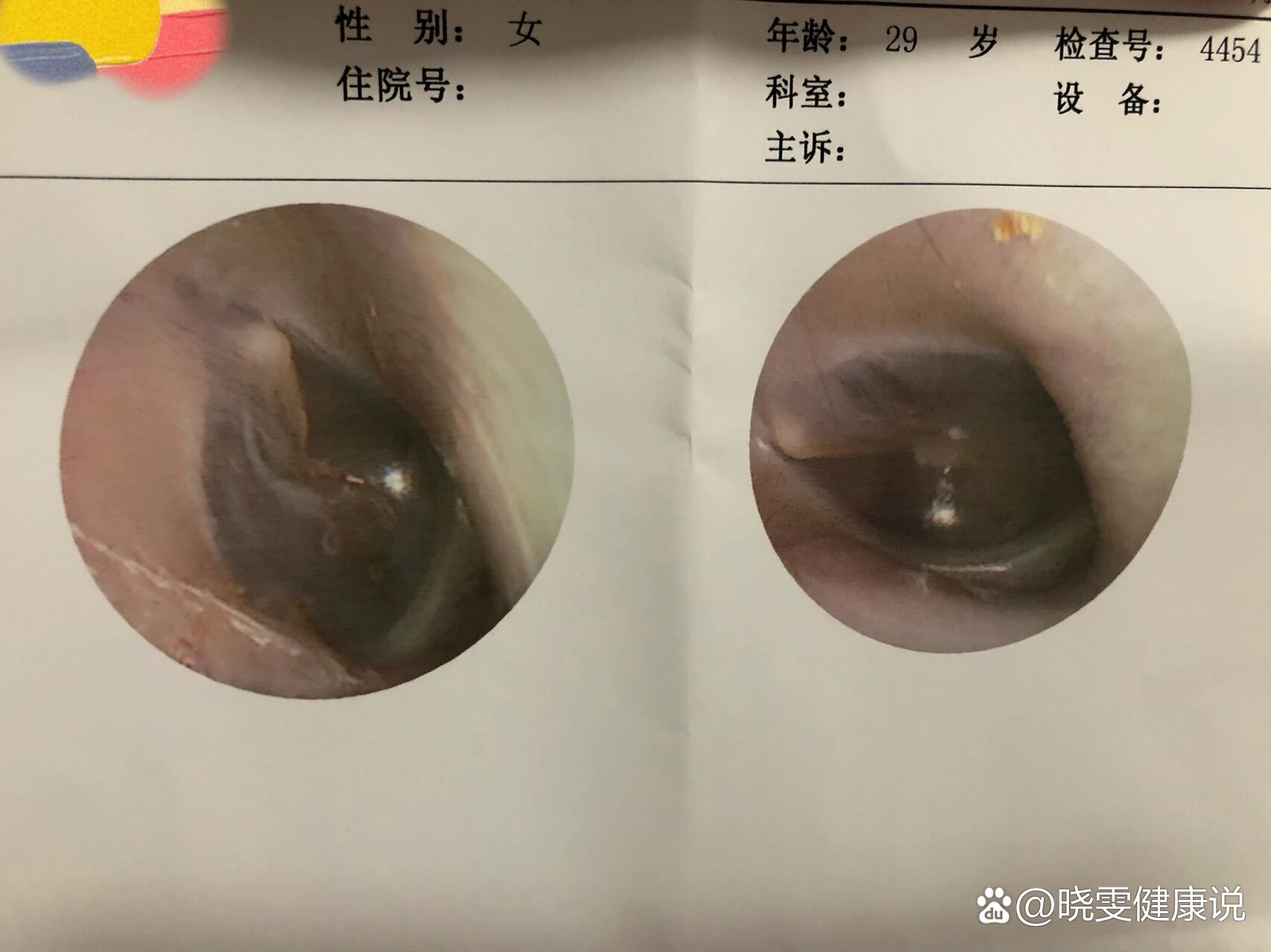 鼓膜穿孔能自愈吗