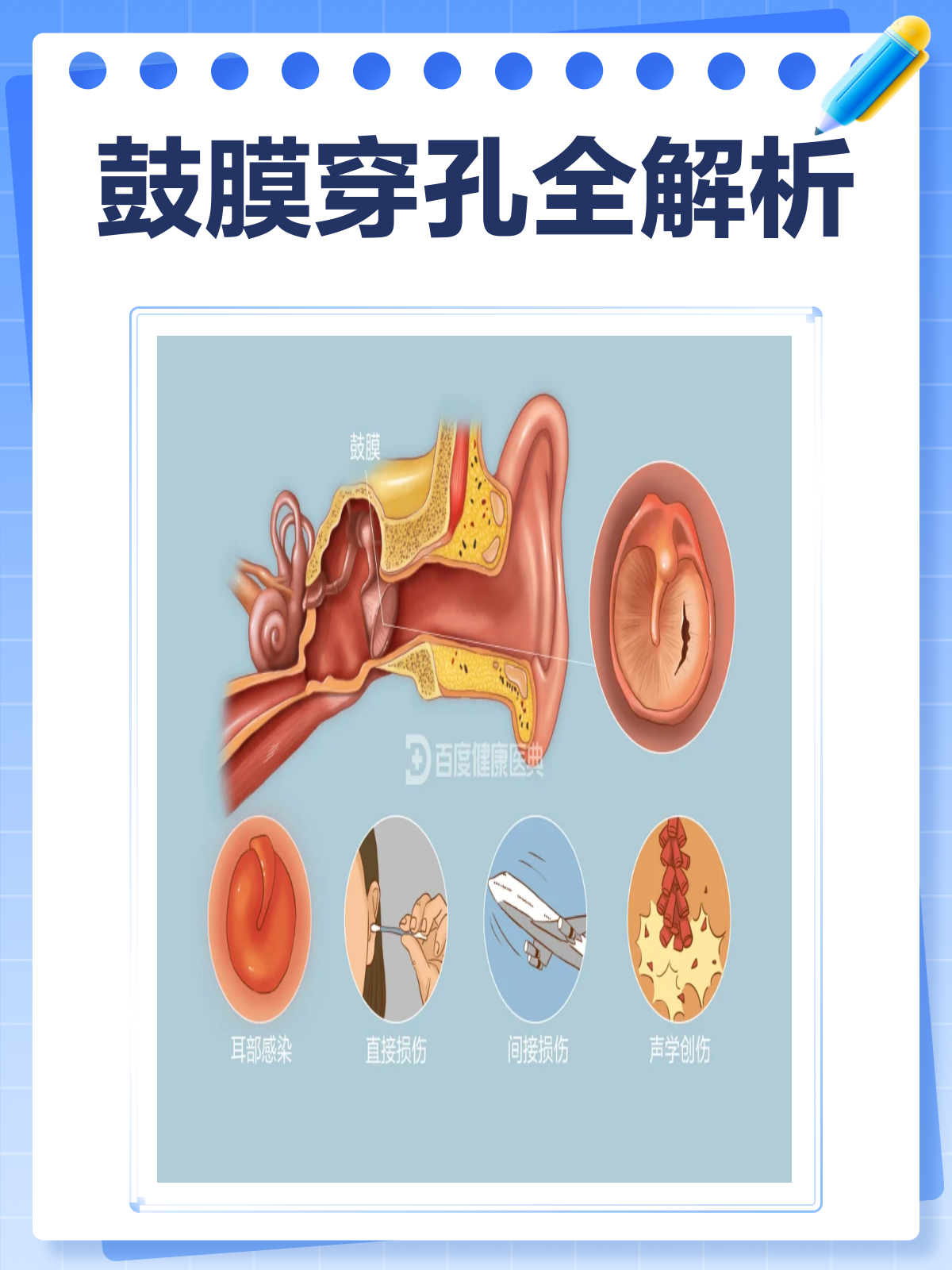 鼓膜穿孔能自愈吗