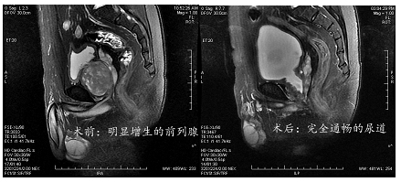 前列腺b超检查诊断意义是什么?
