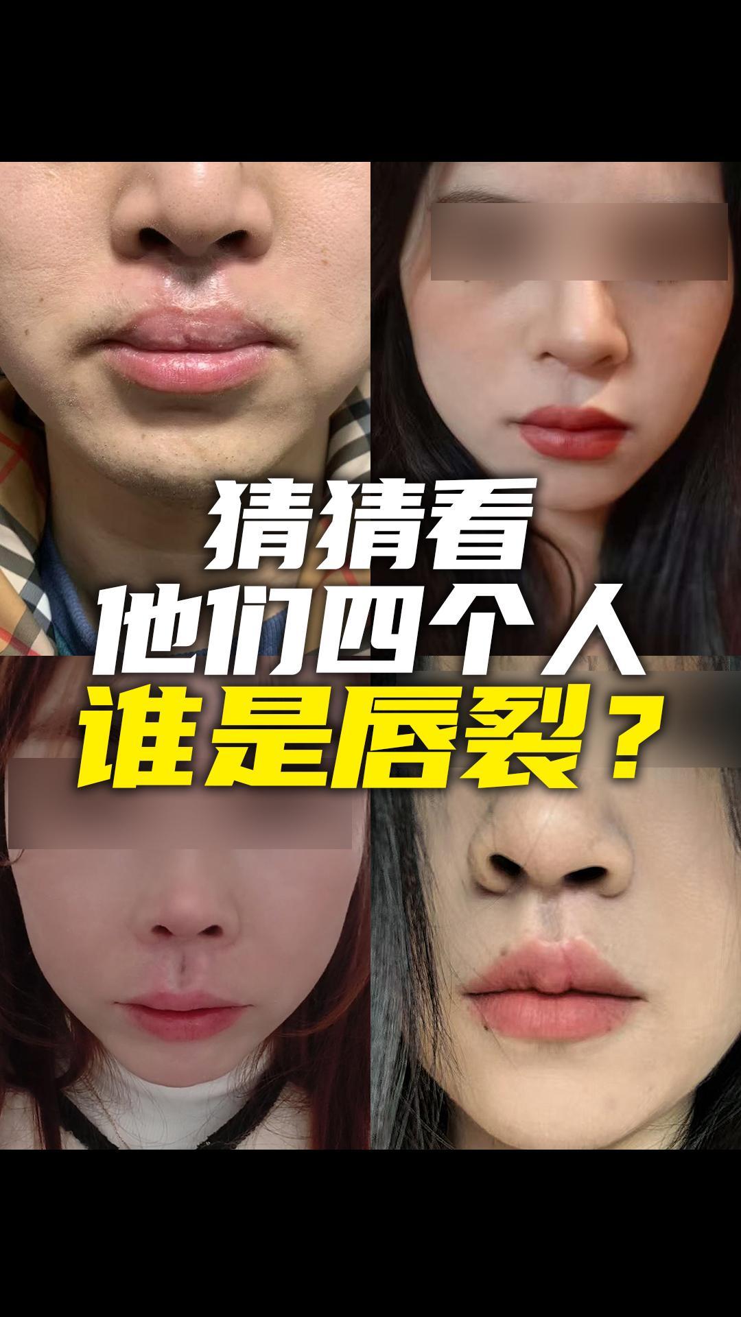 唇腭裂真的会有遗传吗