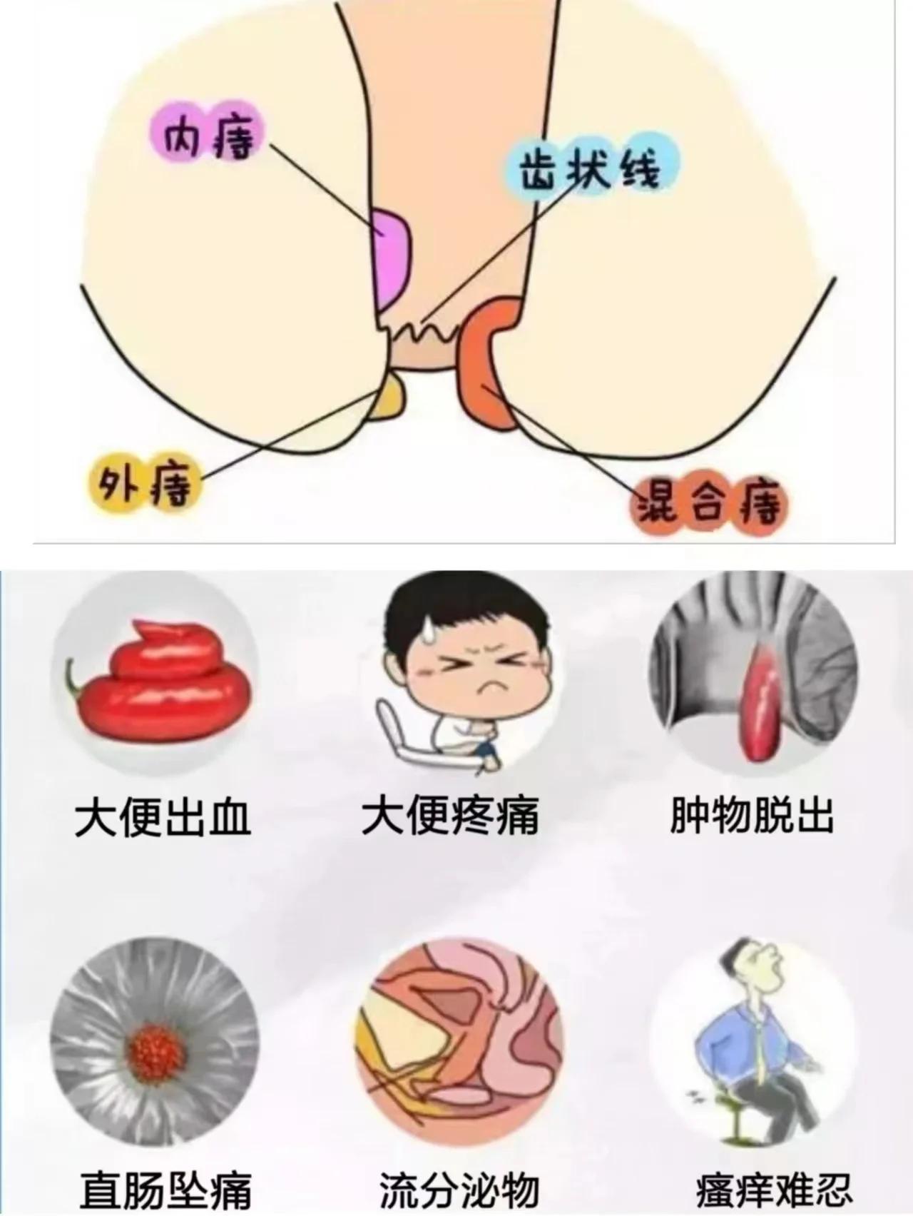 内痔疮怎么治疗