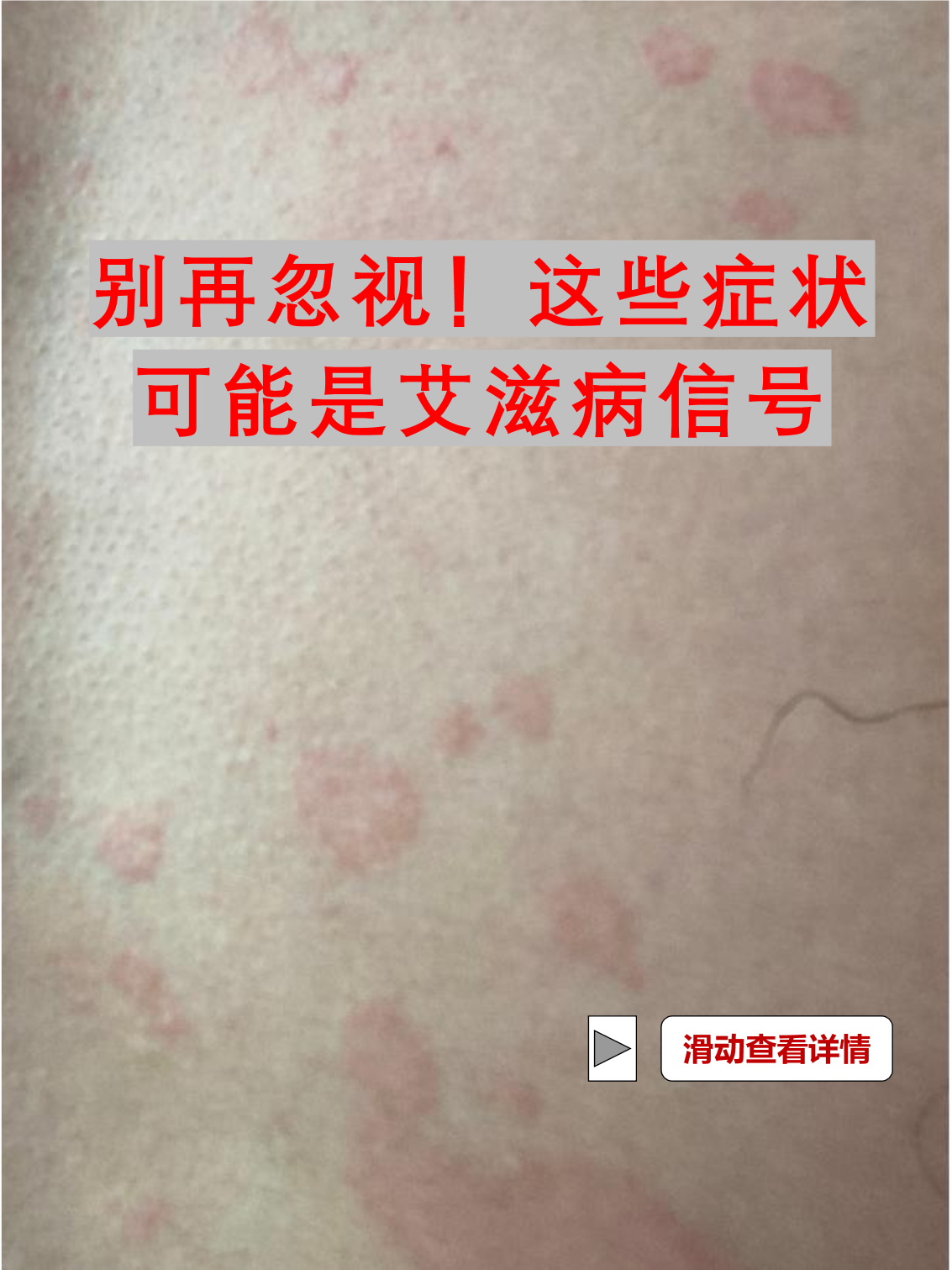 艾滋病早期的症状