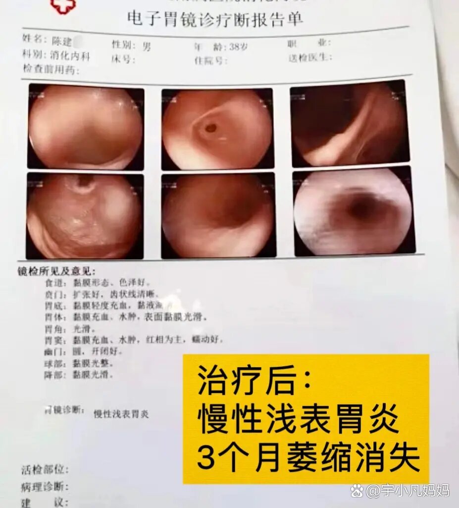 慢性萎缩性胃炎伴肠化能治好吗?