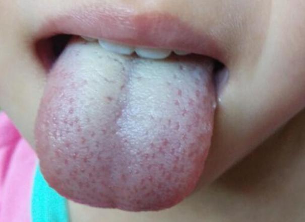 幽门螺杆菌感染的早期症状?