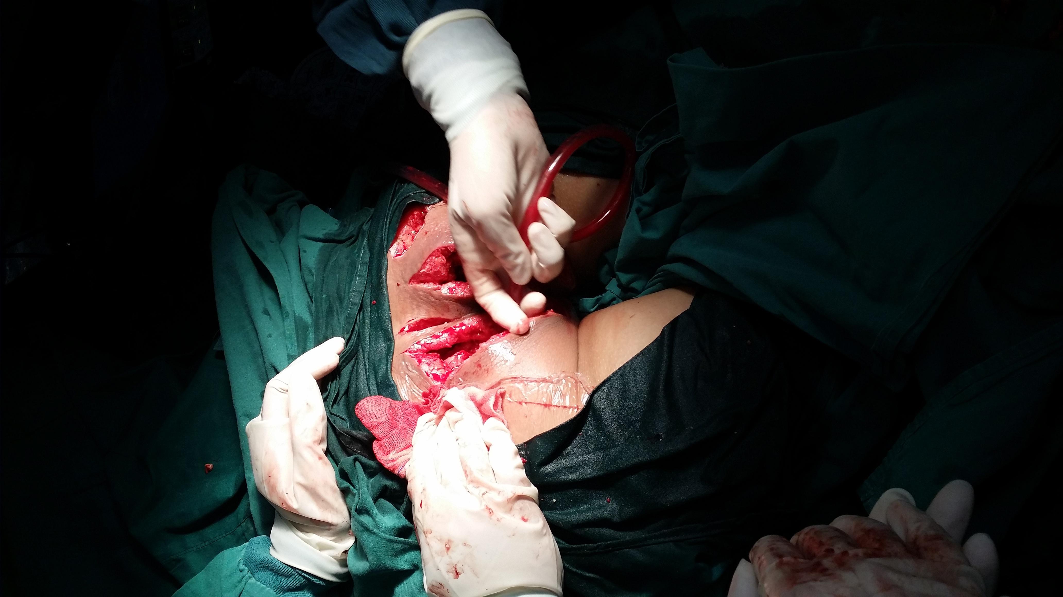 这是我肛瘘切除术11天后的样子