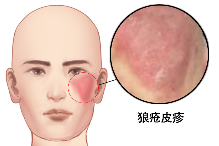 红斑狼疮会痒吗?