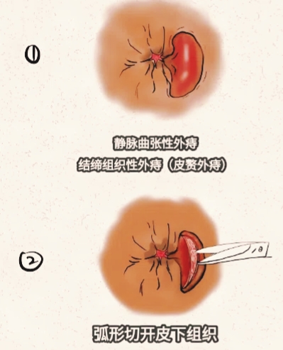 痔疮会自己好吗?