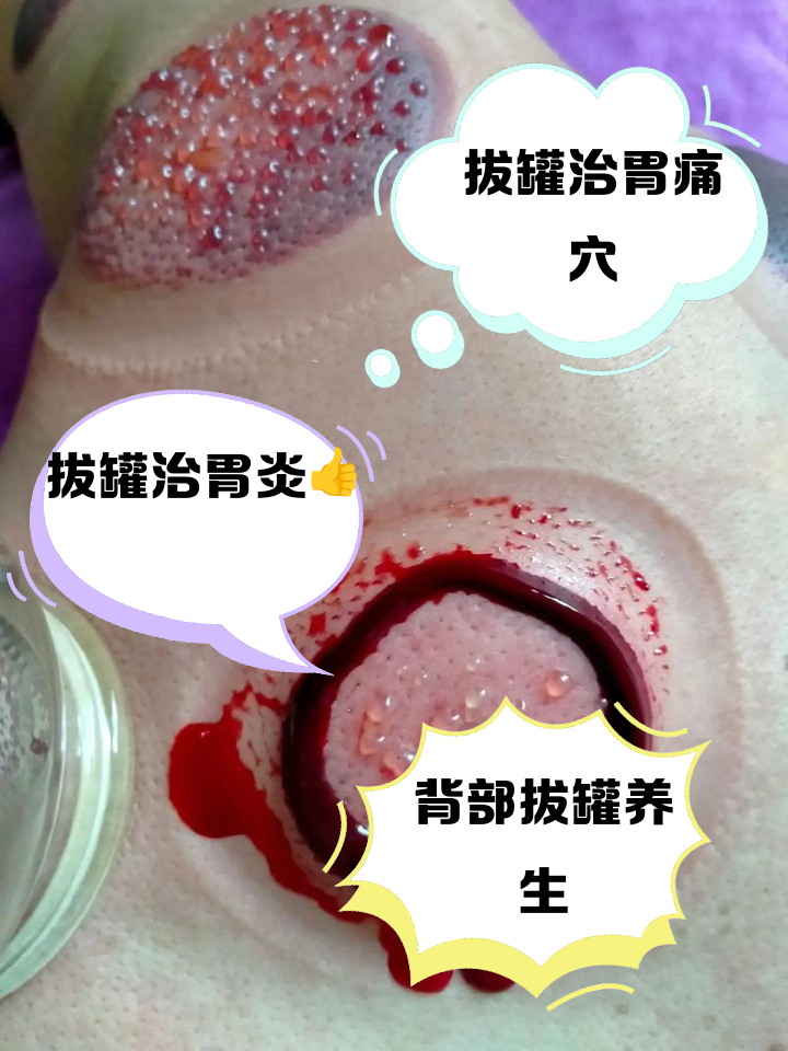 拔罐穴位有哪些