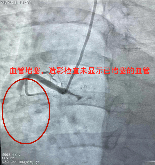 血管造影的副作用