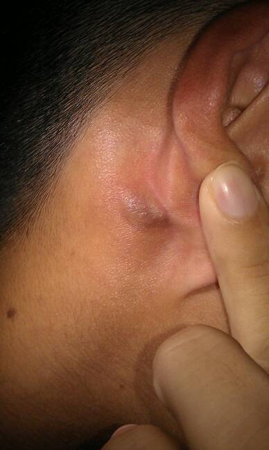 耳朵耳垂里有个硬疙瘩捏着有点疼