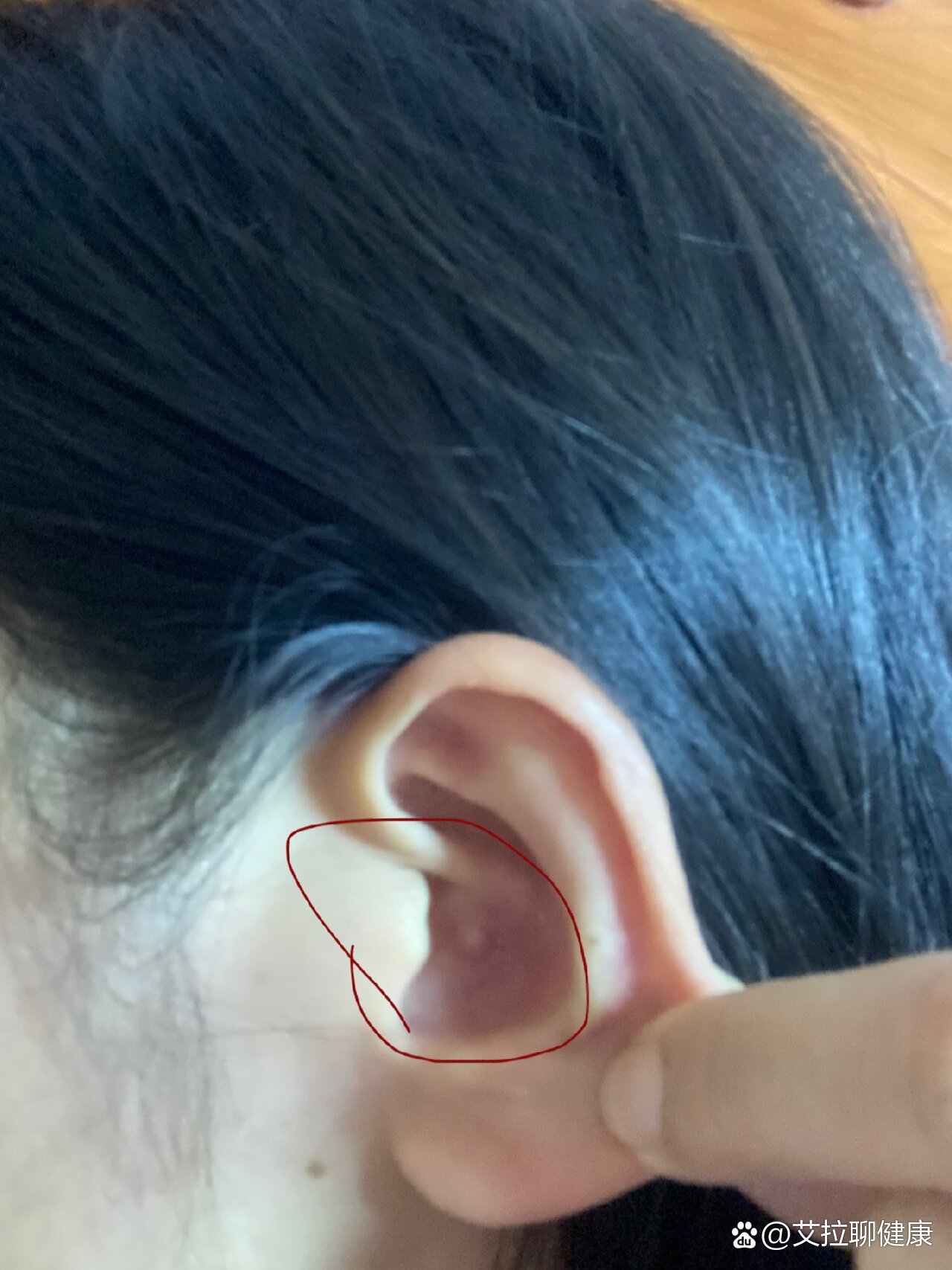 耳朵耳垂里有个硬疙瘩捏着有点疼