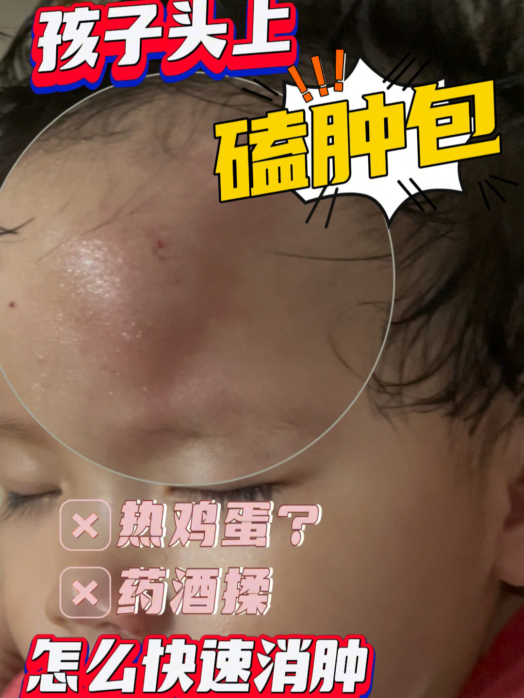 宝宝头部磕了个包,如何消肿